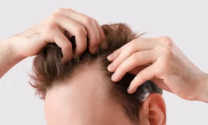 Tricopigmentazione vs Parrucchino: la soluzione definitiva per la calvizie