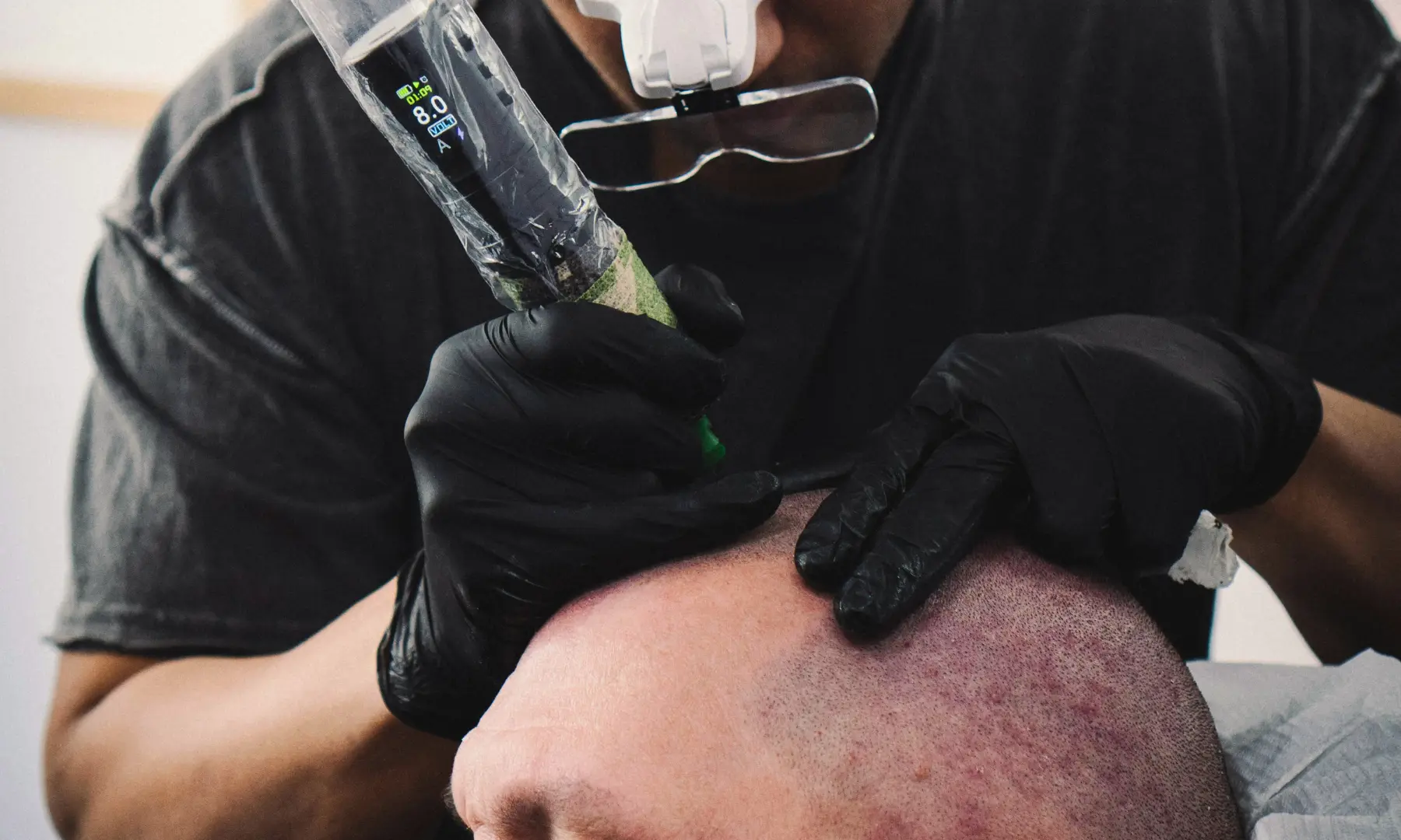 Tricopigmentazione vs Tatuaggio: qual è la differenza?
