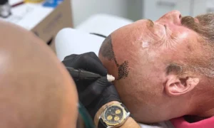 Dalla consulenza al risultato come funziona una seduta di tricopigmentazione