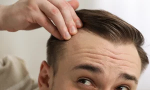 Dallo stress alla calvizie Il percorso nascosto della caduta dei capelli