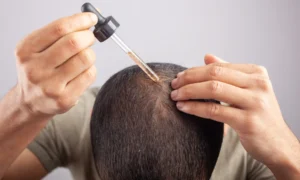 Minoxidil o tricopigmentazione Confronto tra approcci diversi